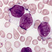 Akútna myeloblastová leukémia