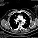 Disekcia hrudníkovej aorty