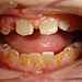 Klinický obraz dentinogenesis imperfecta