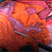 Operačná liečba karcinómu pažeráka a pažerákovo-žalúdkového spojenia podľa Ivor Lewisa