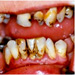 Parodontitis dospelých