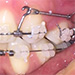 Terapia predhryzu retrakciou frontálnych zubov k dočasným kotviacim zariadeniam (TADs)