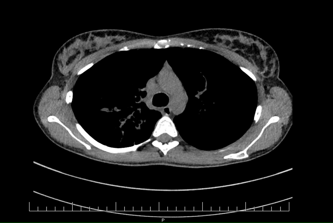 Obrázok 1 - HRCT pľúc dokumentuje prakticky v celom rozsahu pľúcneho parenchýmu obojstranné peribronchiálne fibrózne zmeny so zosilnením peribronchiálneho interstícia a bronchiektáziami.