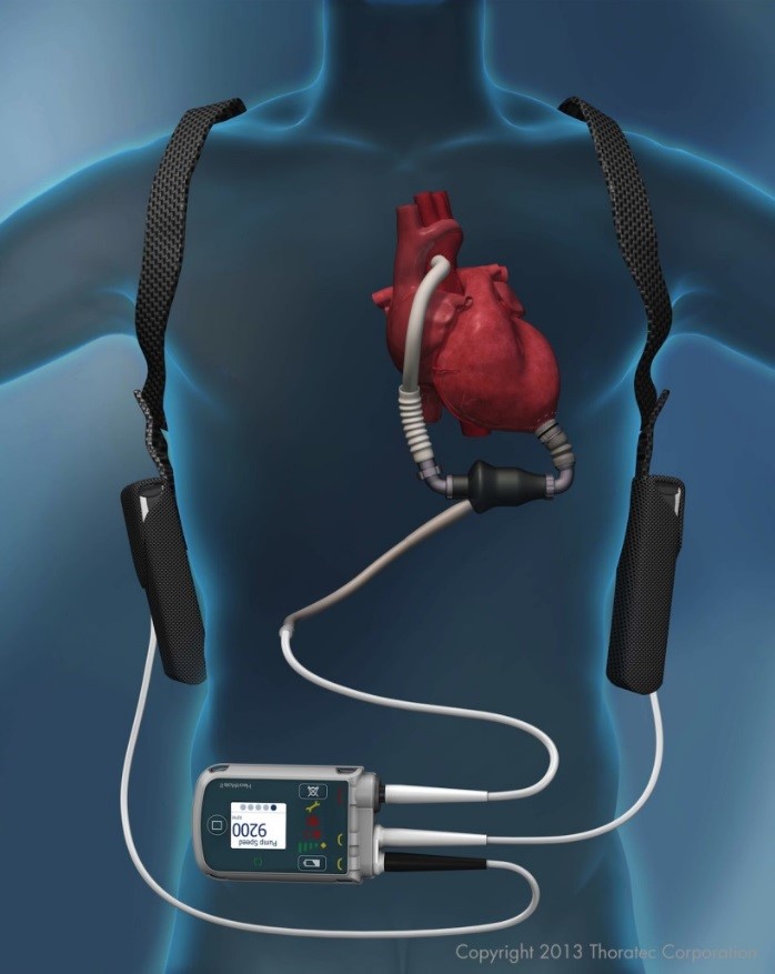 Mechanická podpora v indikácii premostenia - bridging k transplantácii srdca ((c) 2013, Thoratec Corporation).