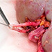 Akútna končatinová ischémia ako prejav včasnej komplikácie po transplantácii obličky