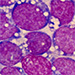 Akútna lymfoblastová leukémia u pacientky s Ph pozitívnym chromozómom