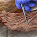 Anatomická pitva - dolná končatina