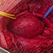 Aneuryzma - Arteria carotis interna