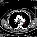 Aortic dissection