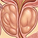 Benign prostatic hyperplasia