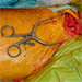 Chirurgická liečba aterosklerotických zmien v oblasti dolných končatín