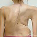 Chronic Respiratory Failure due to Kyphoscoliosis