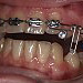 Combined orthodontic-surgical treatment of impacted teeth