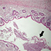 Diverticulitis appendicis vermiformis