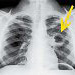 Multiple lung abscesses