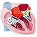 Myocarditis, pericarditis and endocarditis