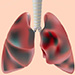 Newly diagnosed COPD - obstructive ventilatory impairment