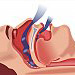 Obstructive sleep apnoea in extremely obese patient