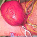 Pacient s hyperfunkčnou dilatovanou AV fistulou
