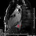 Parainfectious myocarditis