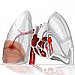 Paraneoplastická pľúcna embólia s pľúcnym infarktom