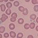 Platelet disorders, Bleeding disorders, Leukemias