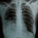 Pleuropneumonia