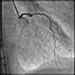 Posterior wall myocardial infarction