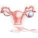 Tuboovariálna junkcia ako kľúčová štruktúra v prípade ovariálneho karcinómu